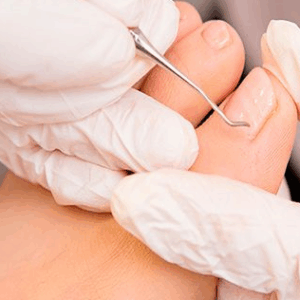 PEDICURIA